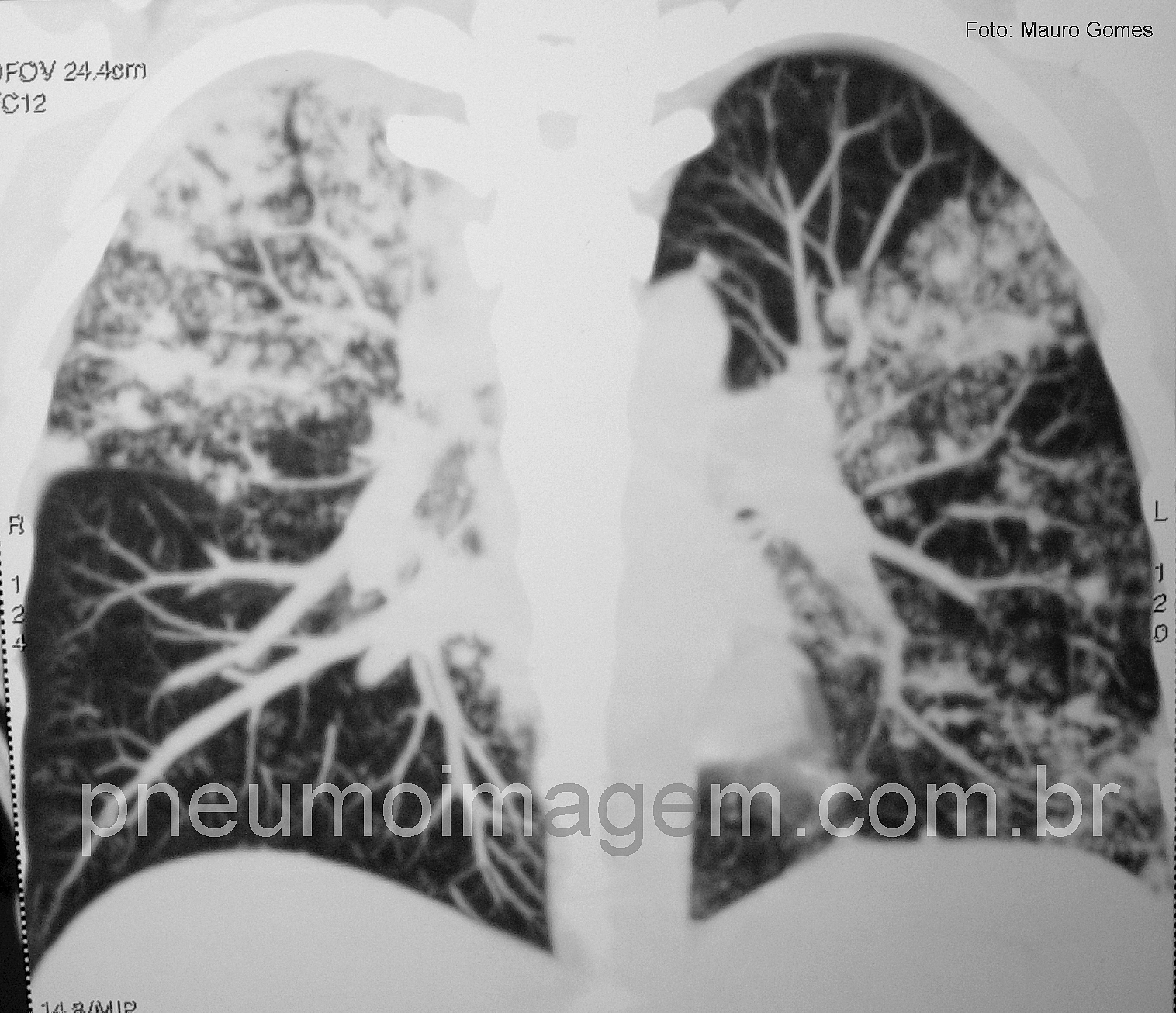 OMS LANÇA MANUAL COM ESTRATÉGIAS PARA O FIM DA TUBERCULOSE: FAÇA O DOWNLOAD OMS LANÇA MANUAL COM ESTRATÉGIAS PARA O FIM DA TUBERCULOSE: FAÇA O DOWNLOAD
